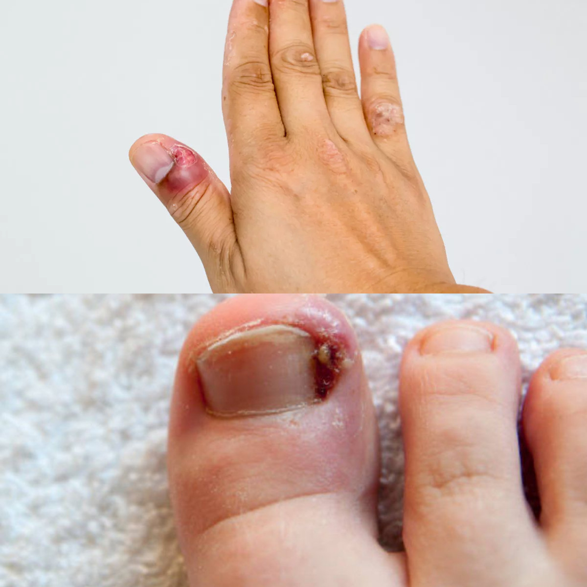 Cara Menyembuhkan Cantengan yang Cepat dan Efektif!