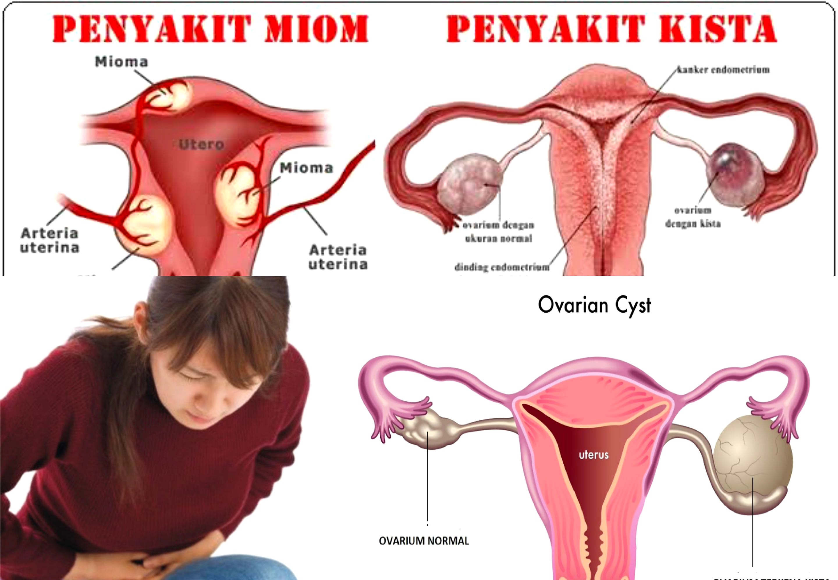 Momok Bagi Wanita. Yuk Mengenal Tumor Rahim dan Kista. Ini Penjelasannya