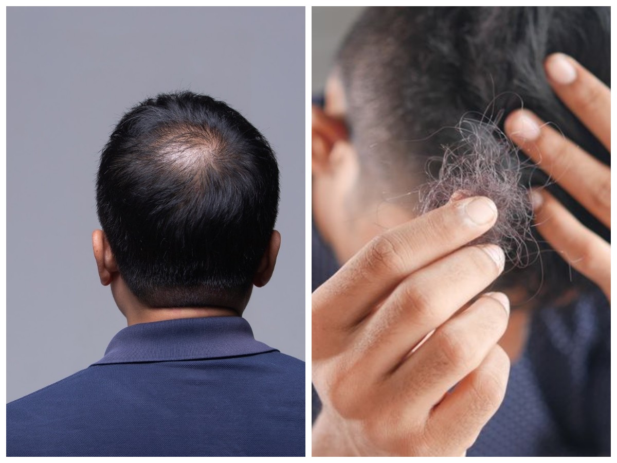 Sering Alami Rambut Rontok? Begini Cara Menjaga Rambut Pria Tetap Sehat dan Tumbuh Lebat!