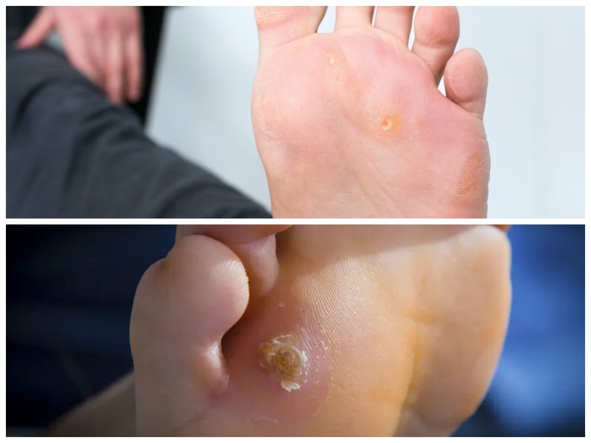 Mata Ikan pada Kaki: Solusi Praktis untuk Mengatasi Masalah Kaki Anda