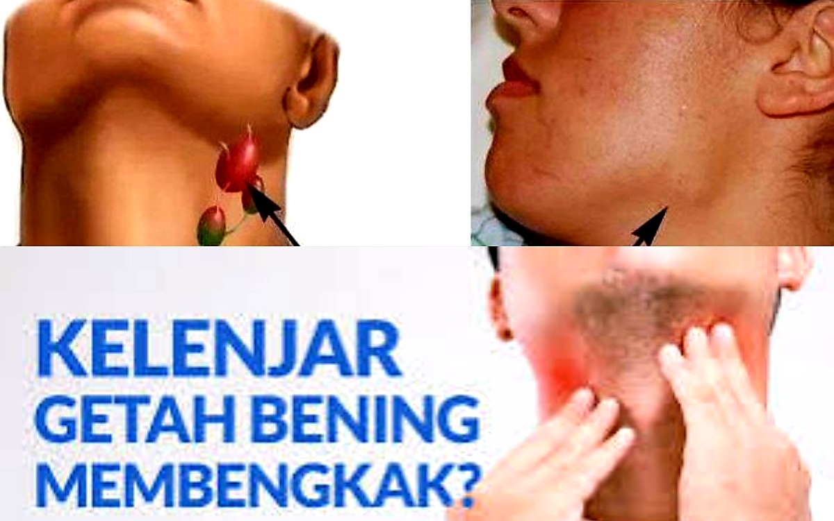 Kuatir Karena Pembengkakkan Getah Bening? Ini Tips Pengobtan dan Meredakannya