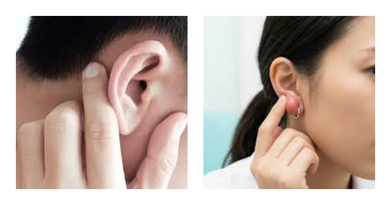 Benjolan di Daun Telinga: Penyebab dan Cara Mengatasinya