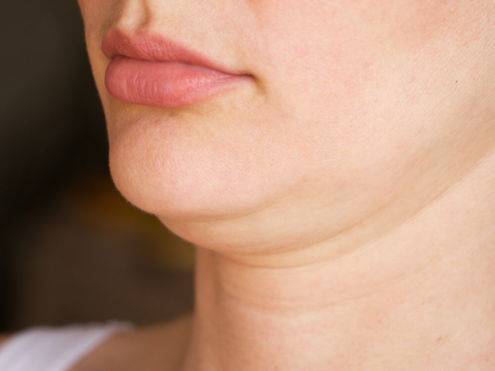 Apa Penyebab Double Chin dan Bagaimana Cara Mengatasinya? Yuk Simak Penjelasannya