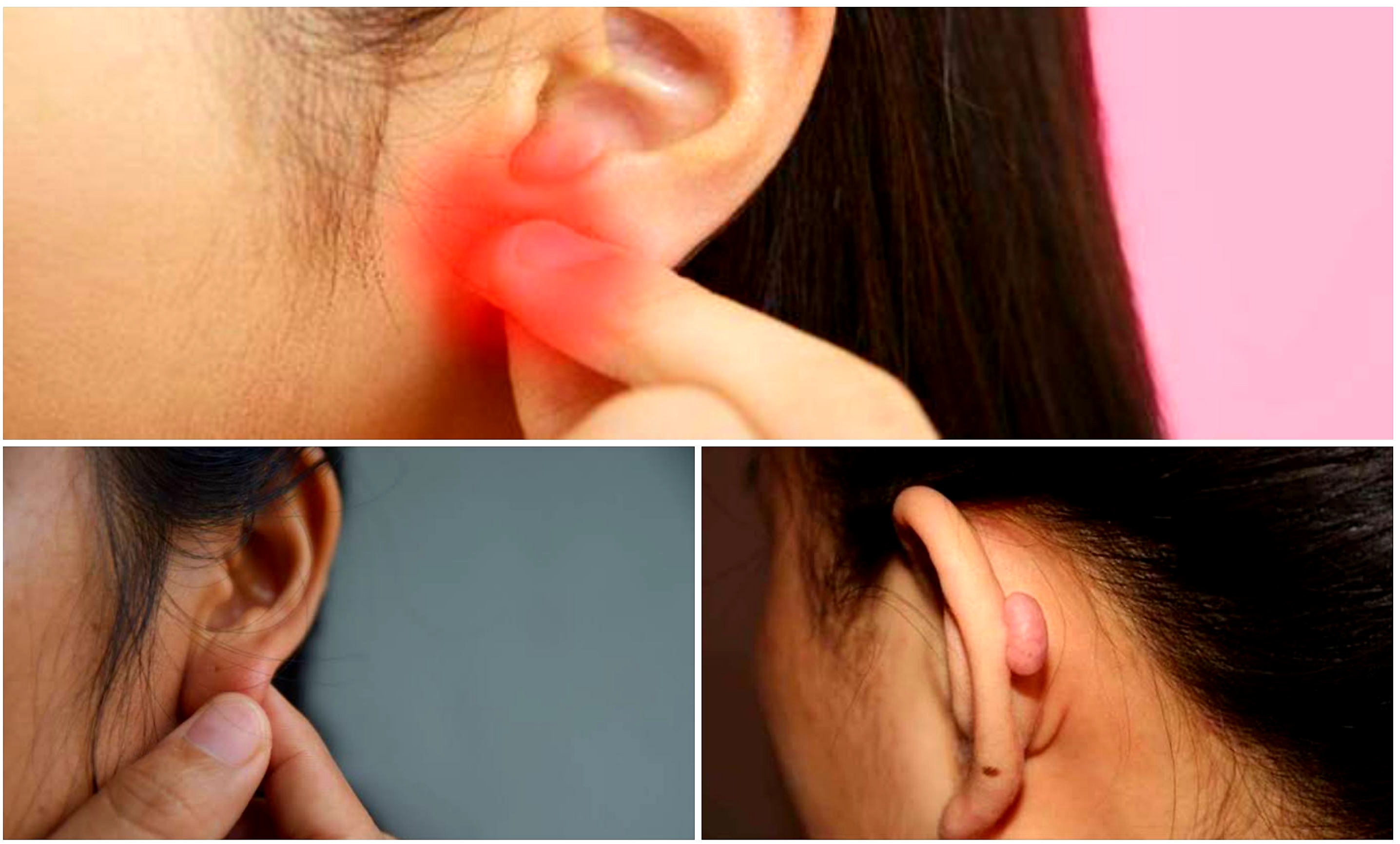 Tak Selalu Berbahaya. Kenali 4 Jenis Benjolan di Telingan dan Begini Cara Mengatasinya