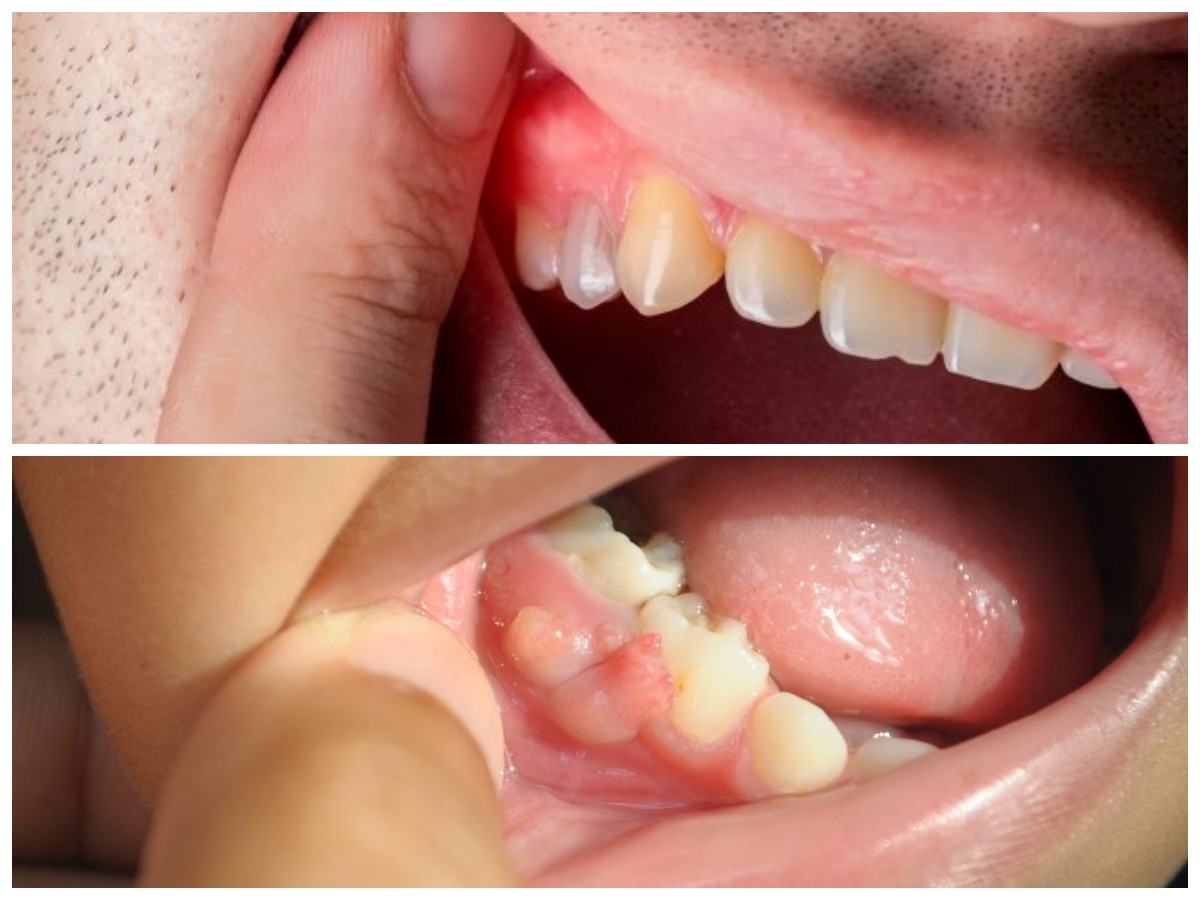 Cara Ampuh Mengatasi Gusi Bengkak dan Berdarah dengan 10 Langkah Praktis