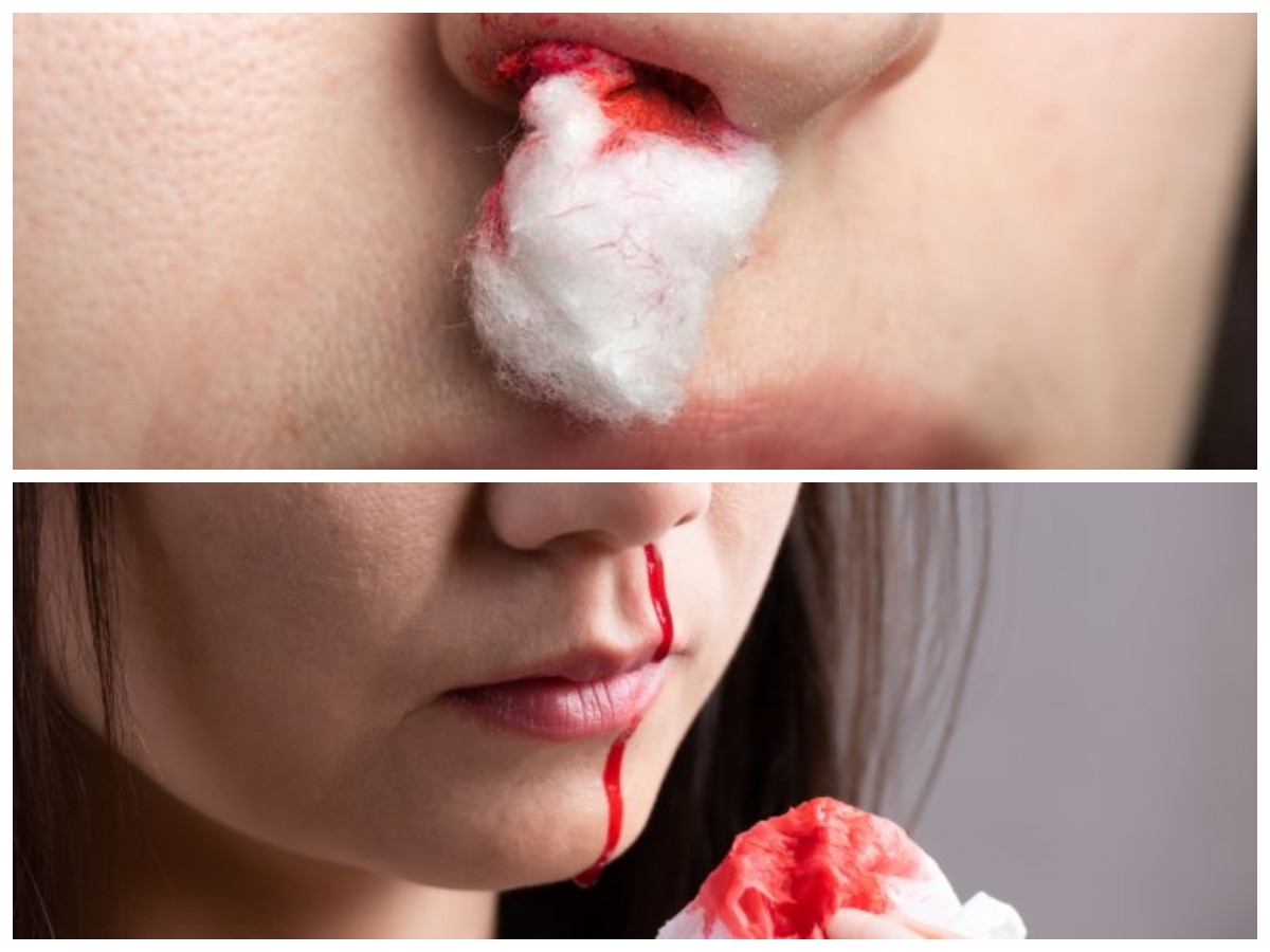 Mimisan Tidak Lagi Menakutkan: Penyebab, Penanganan, dan Cara Mencegahnya