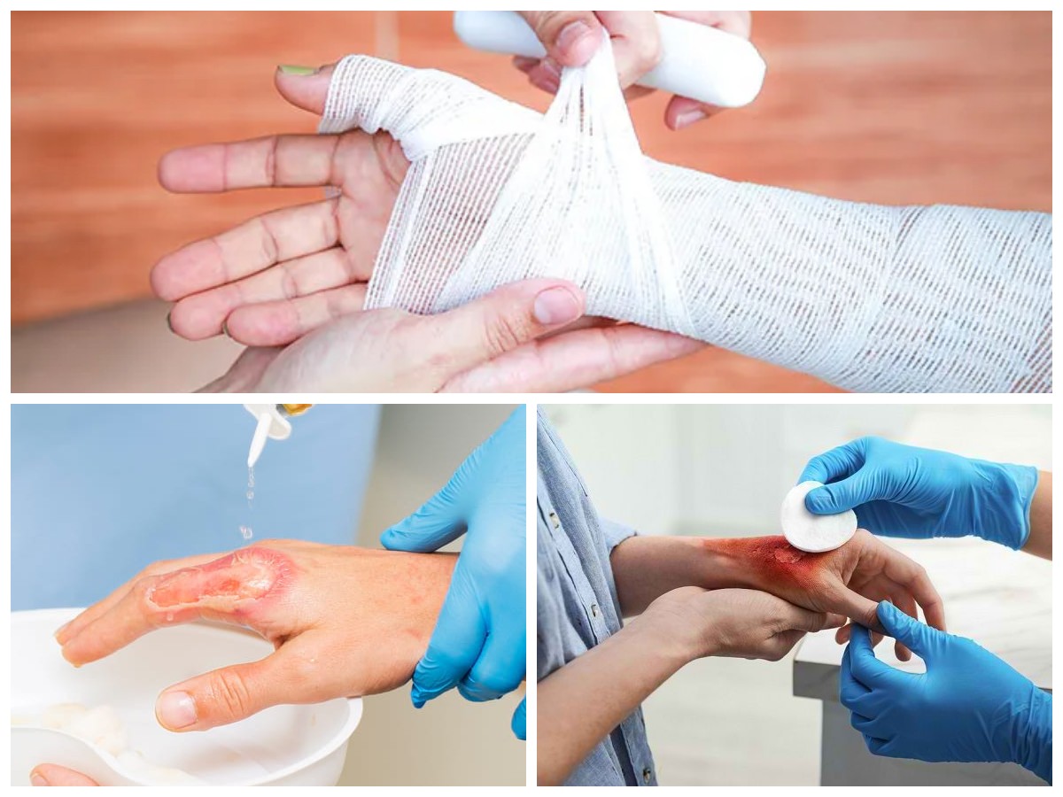 Tips Aman Perawatan Diri untuk Luka Bakar: Panduan Praktis Agar Cepat Pulih dan Terhindar dari Komplikasi!