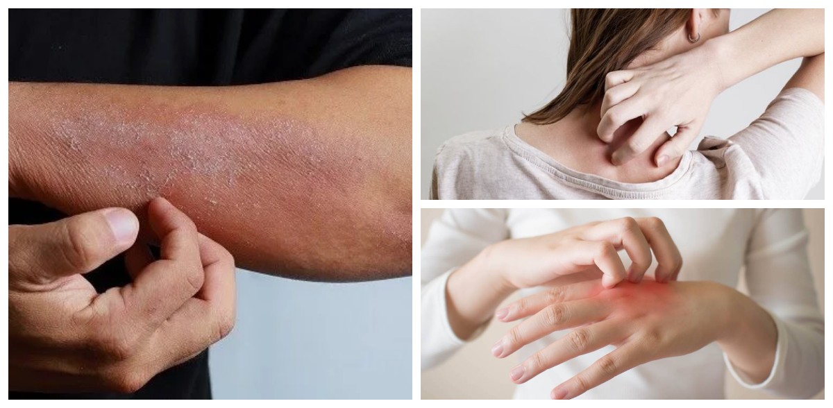 Jangan Anggap Remeh! Kulit Kering dan Gatal Bisa Jadi Tanda 8 Masalah Kesehatan Serius