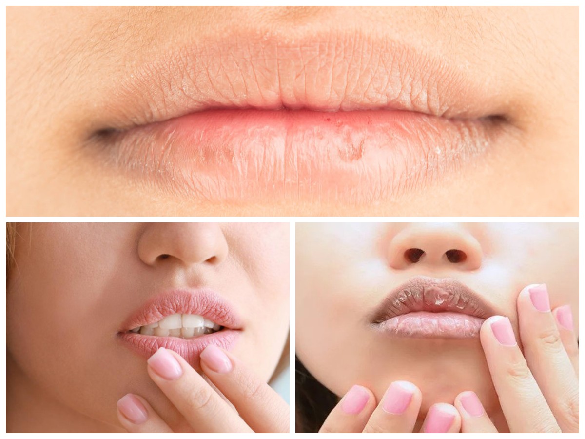 Bibir Kering? inilah Berbagai Cara/Tips Mencegah Bibir Kering!