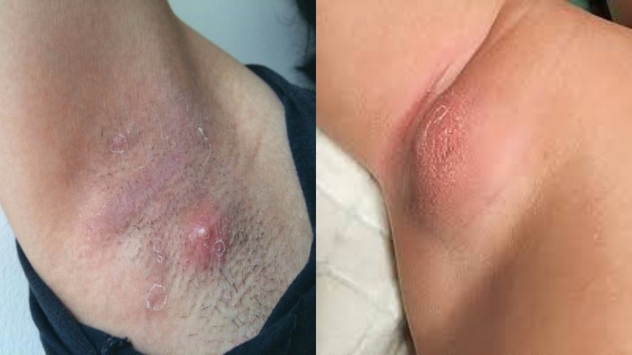 Penyebab Bisul di Ketiak dan Cara Mengatasinya, Kenali Agar Tidak Kambuh!