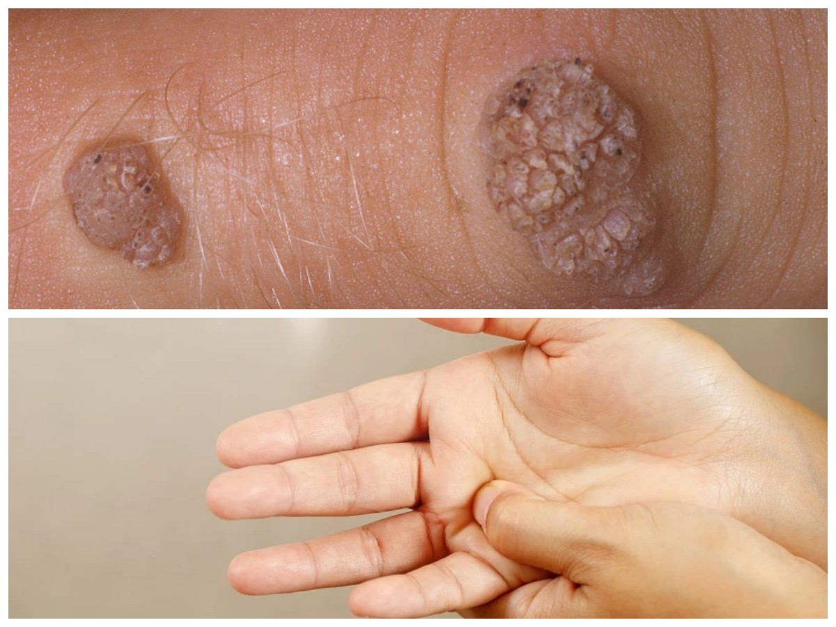 Mata Ikan di Tangan: Kenali Penyebab dan Langkah-Langkah Perawatan yang Efektif