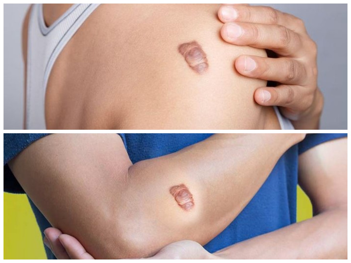 Atasi Luka Keloid dengan Mudah, Coba Tips dan Cara Berikut Ini!