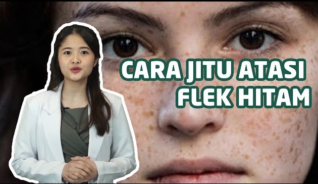 Wajah Mulus Tanpa Biaya Mahal! Coba 5 Cara Alami Ini untuk Hilangkan Flek Hitam dalam Hitungan Hari!