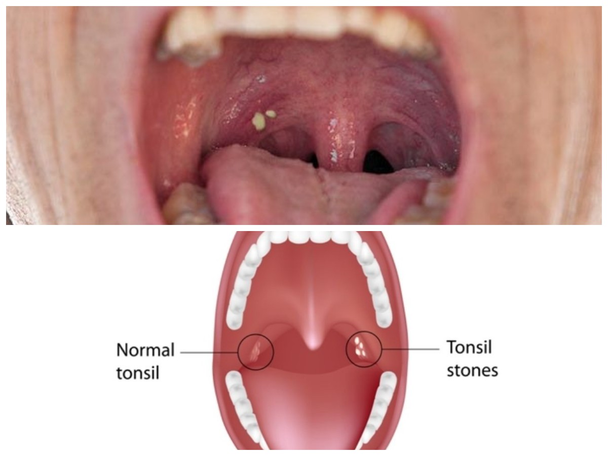 Faktor Penyebab Batu Amandel dan Cara Efektif Menghindarinya