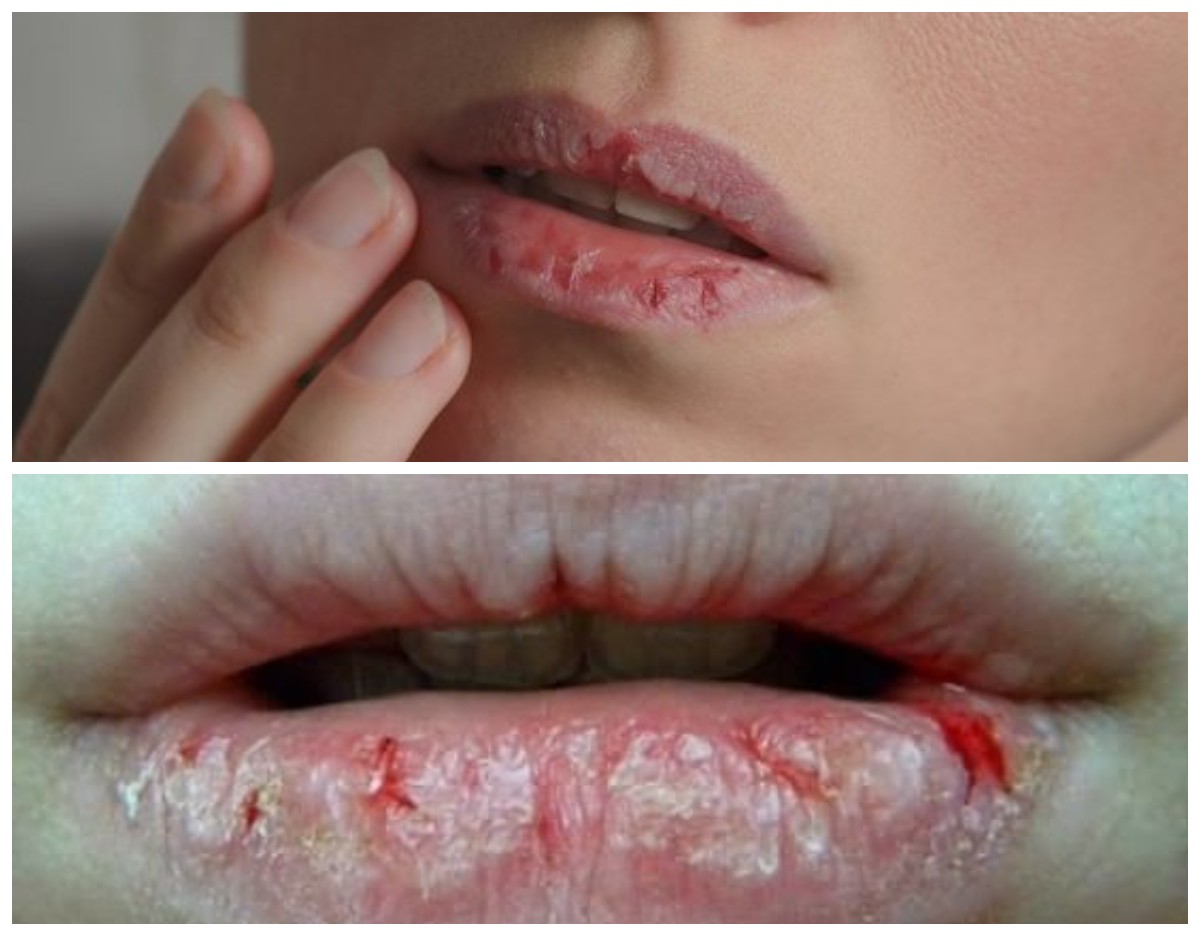 Catat! Ternyata Begini Tips Ampuh Mencegah Bibir Kering 