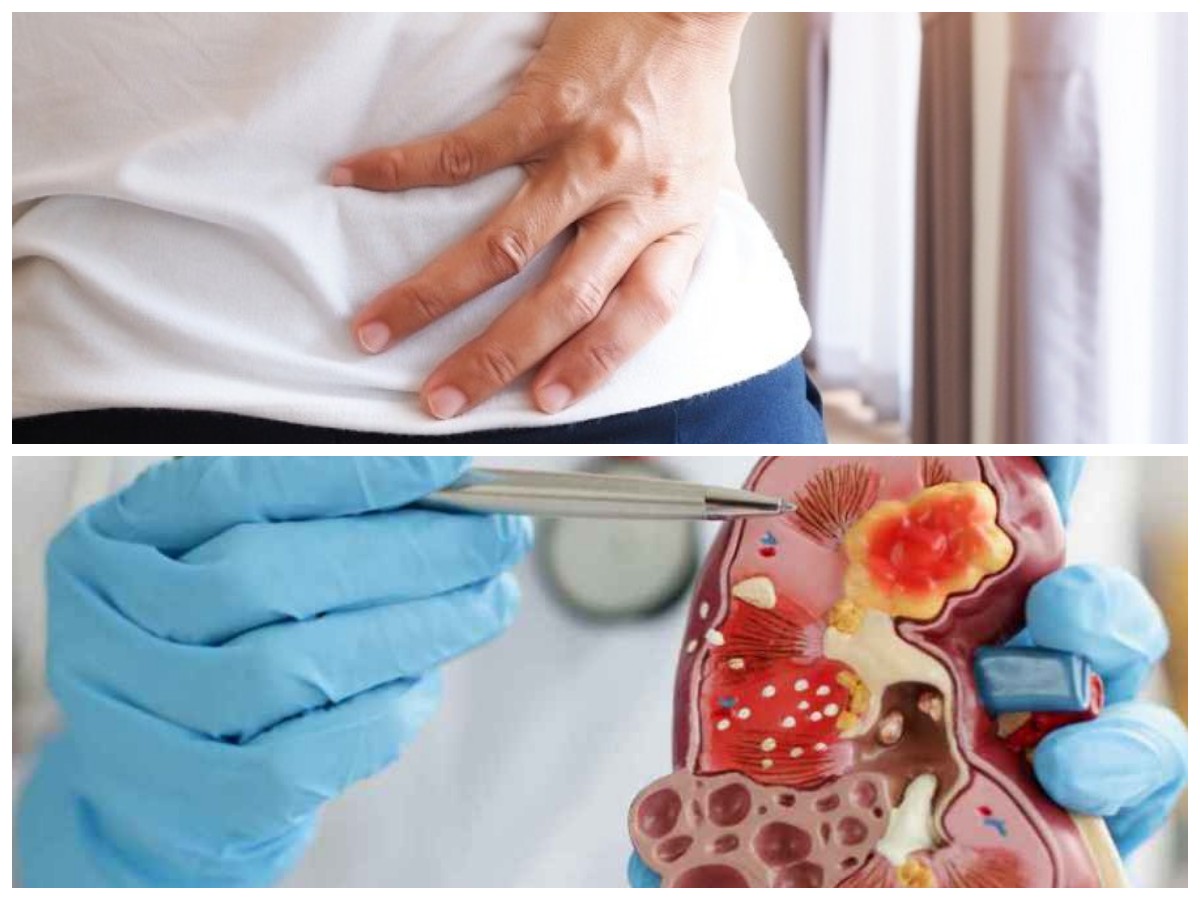 Cara Tepat Menangani Penyakit Ginjal di Stadium Awal agar Tidak Bertambah Parah