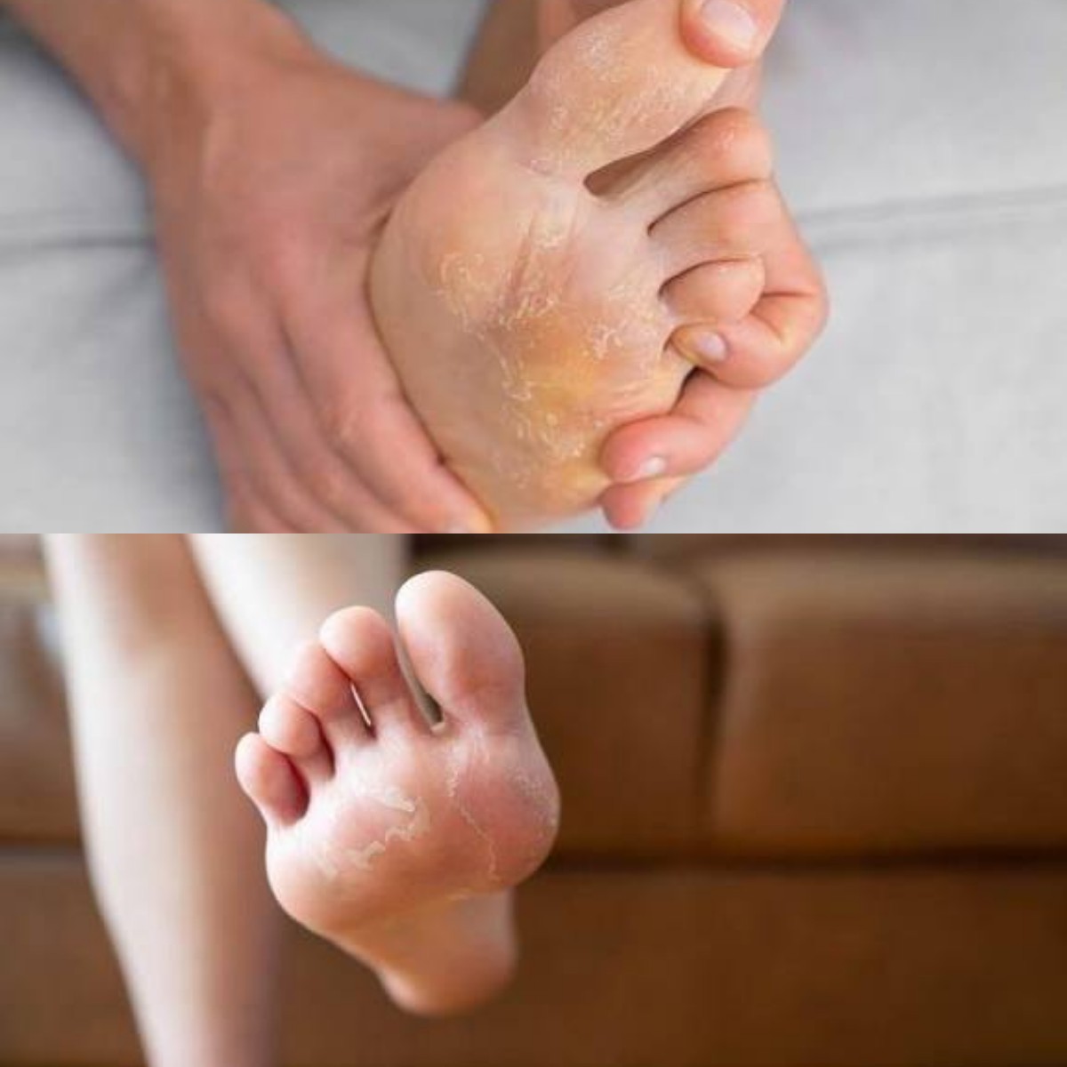 Kembali Mulus Bebas Gatal! Ini Cara Ampuh Mengatasi Kulit Kaki Pecah-Pecah dan Mengelupas