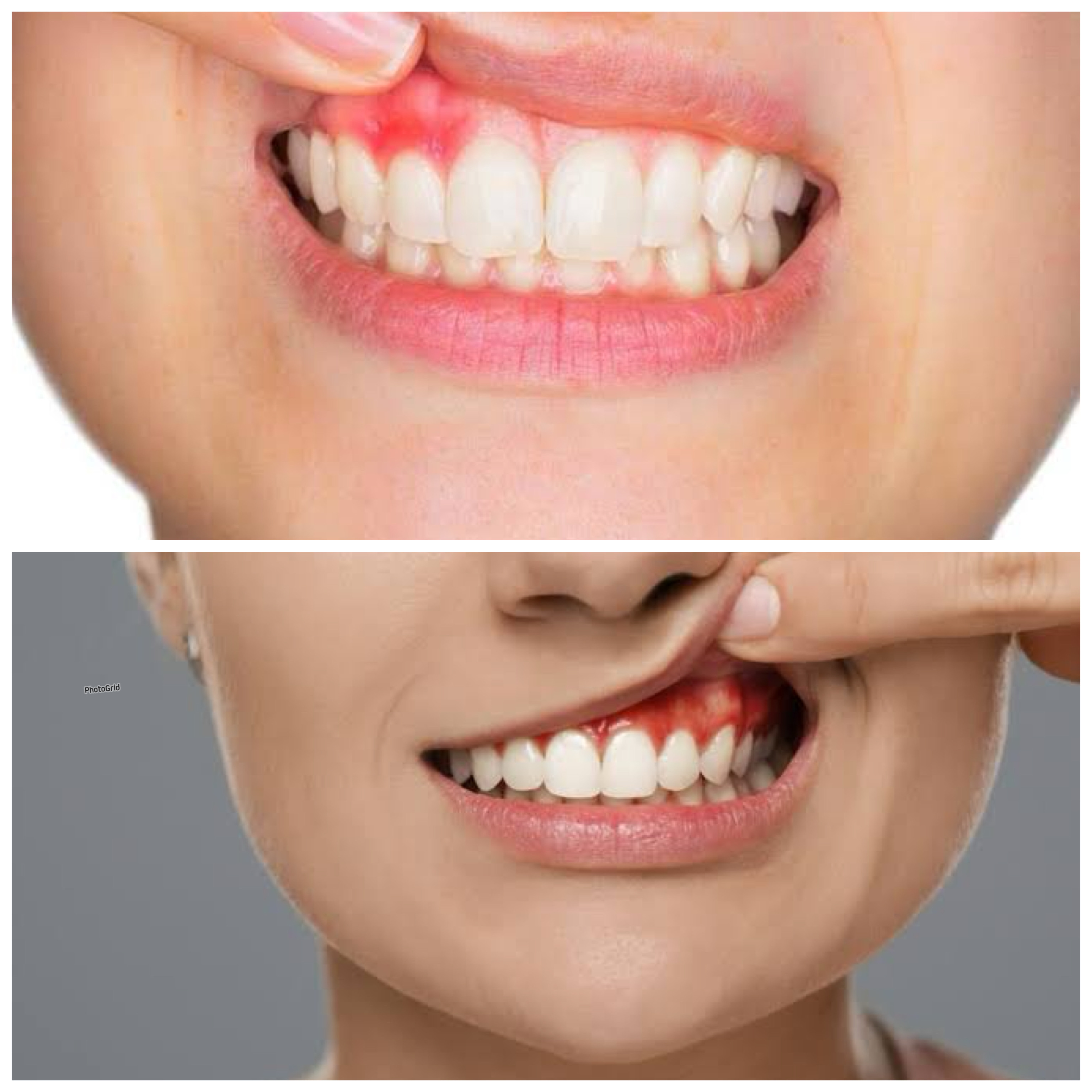 Mengatasi Gusi Bengkak dan Mengetahui Penyebabnya yang Mengganggu Kesehatan Mulut!