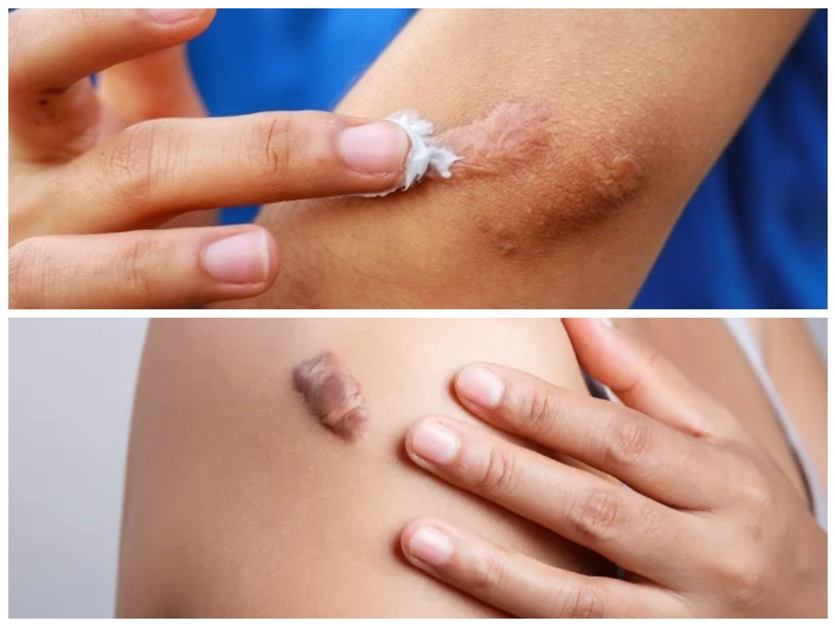 Rekomendasi Cream Penghilang Bekas Luka Mudah Didapatkan di Apotek
