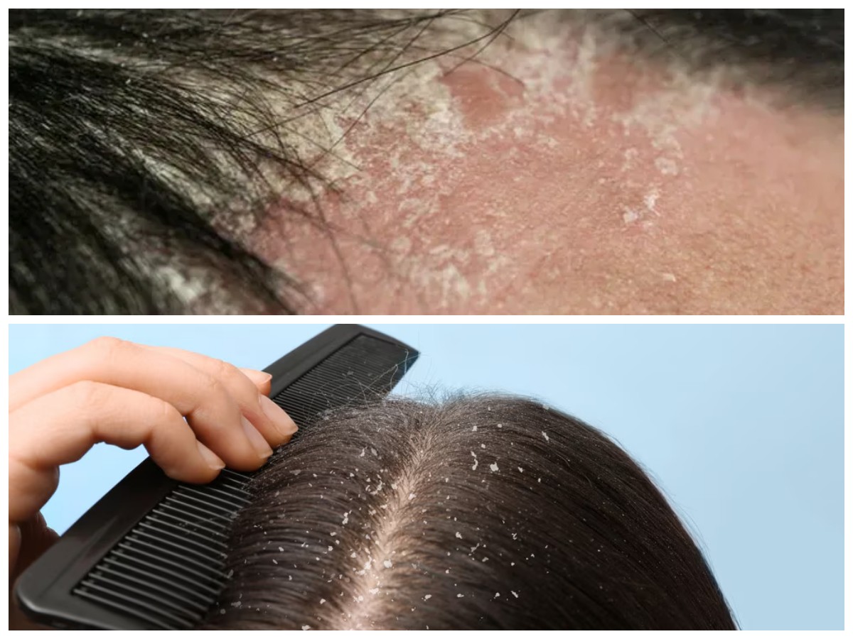 Tips Efektif Menyingkirkan Ketombe yang Sulit Hilang