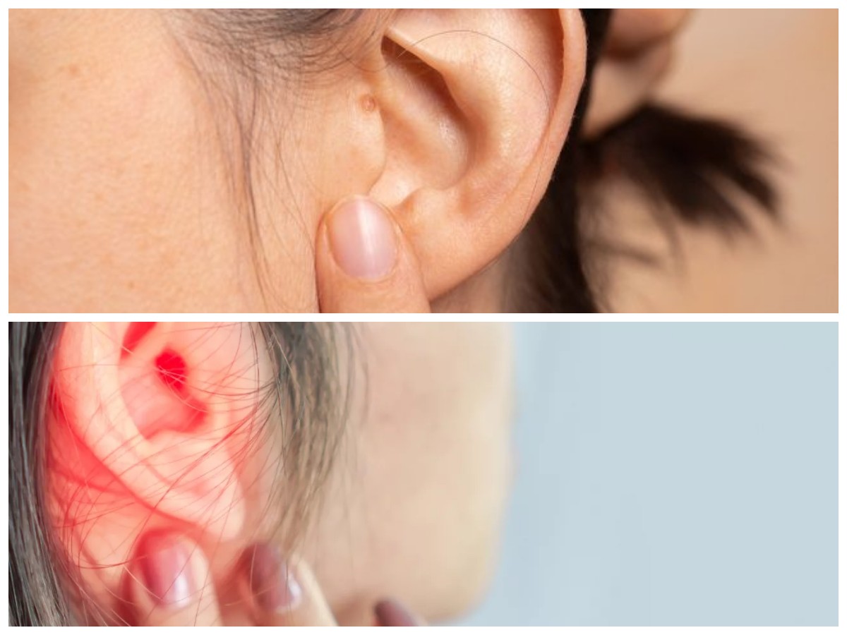 Kenali 6 Penyebab Benjolan di Dalam Telinga dan Cara Tepat Mengobatinya