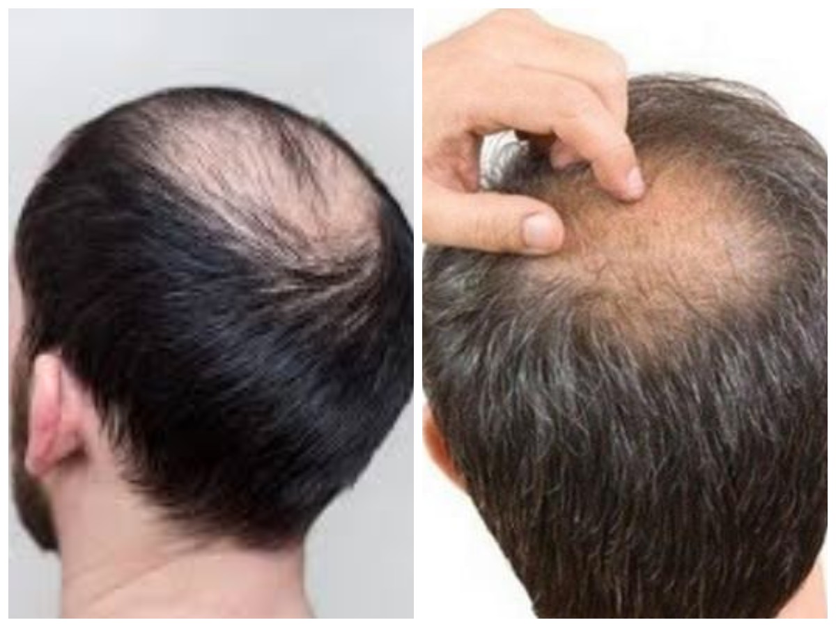 Bosan Mengalami Kebotakan? Kenali Penyebab dan Tips penumbuhan rambut!