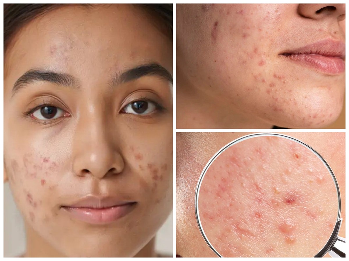 Tips Menghilangkan Bekas Jerawat Hitam Secara Alami: Cara Ampuh Merawat Kulit Wajah agar Kembali Cerah!