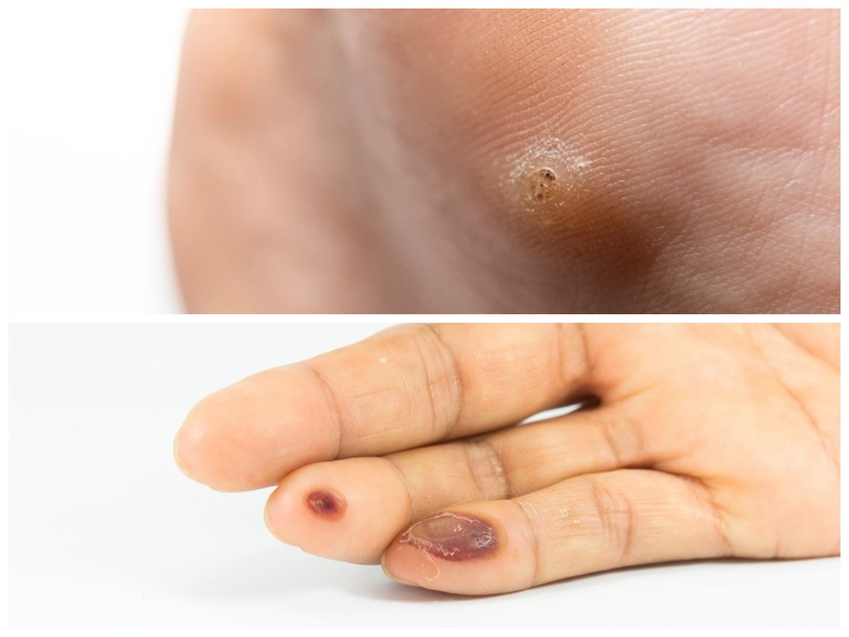 Cara Tepat Mengobati Mata Ikan di Tangan: Penyebab dan Langkah Penanganan yang Ampuh