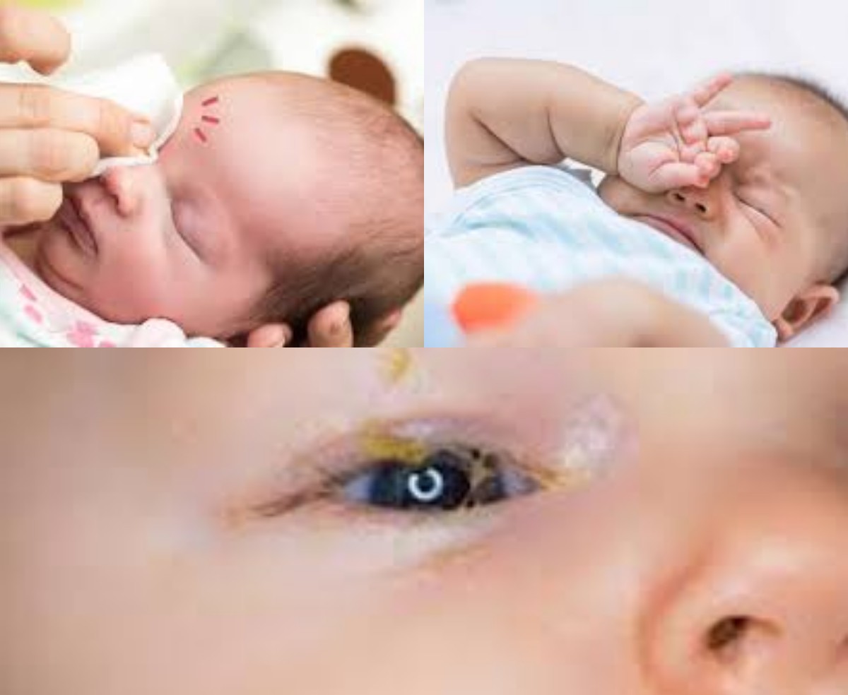 Mata Bayi Sering Belekan, Normalkah? Ini Penyebab, Penanganan, dan Cara Mencegahnya
