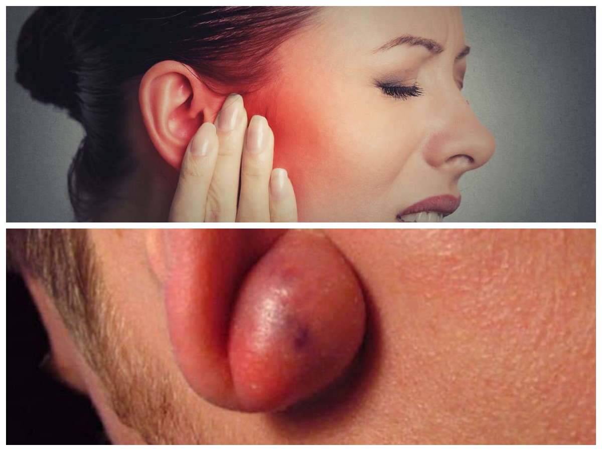 Benjolan di Daun Telinga? Kenali Penyebab dan Cara Mengatasinya dengan Tepat