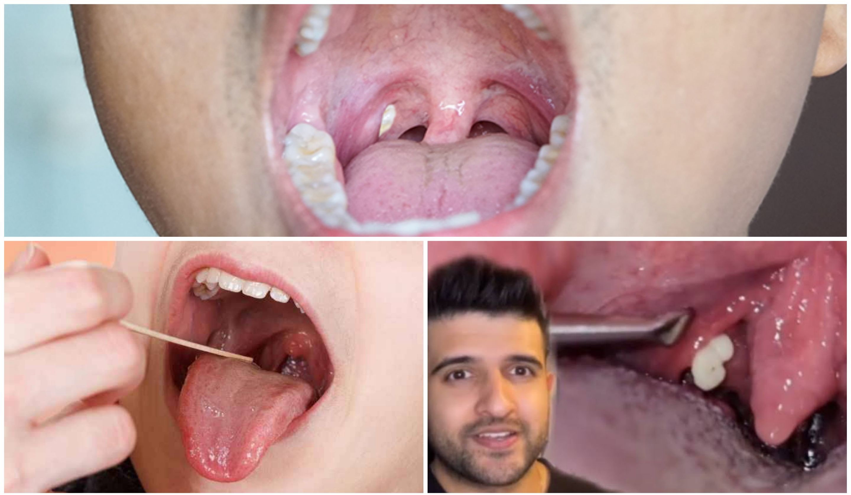 Radang Tenggorokan Karena Amandel Bikin Mulut Bau? Yuk Cari Tahu!