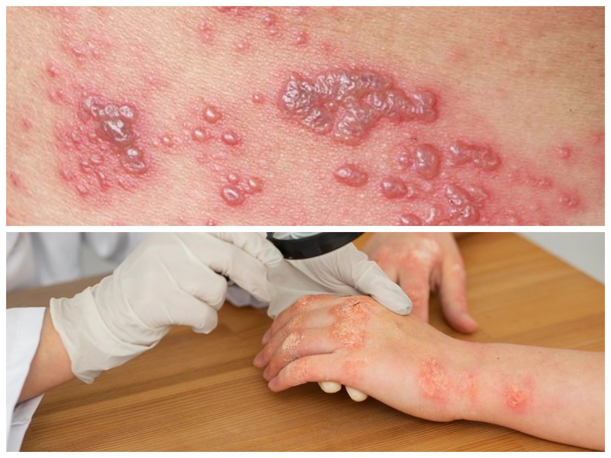 Infeksi Kulit oleh Bakteri: Gejala, Risiko, dan Cara Mengatasinya Sejak Dini