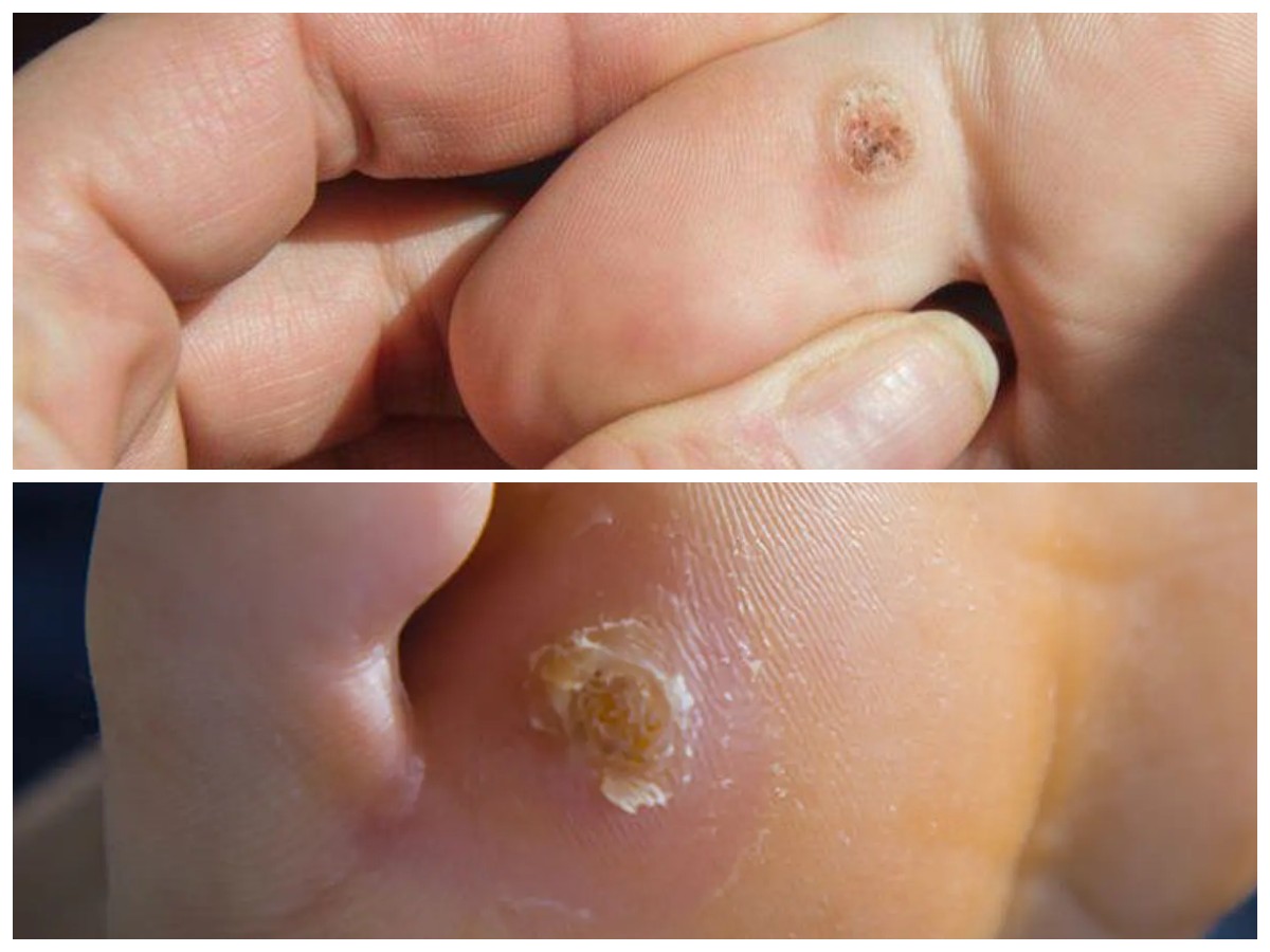 Malu Karena Mata Ikan di Kaki? Ini Penyebab dan Solusi Ampuhnya!