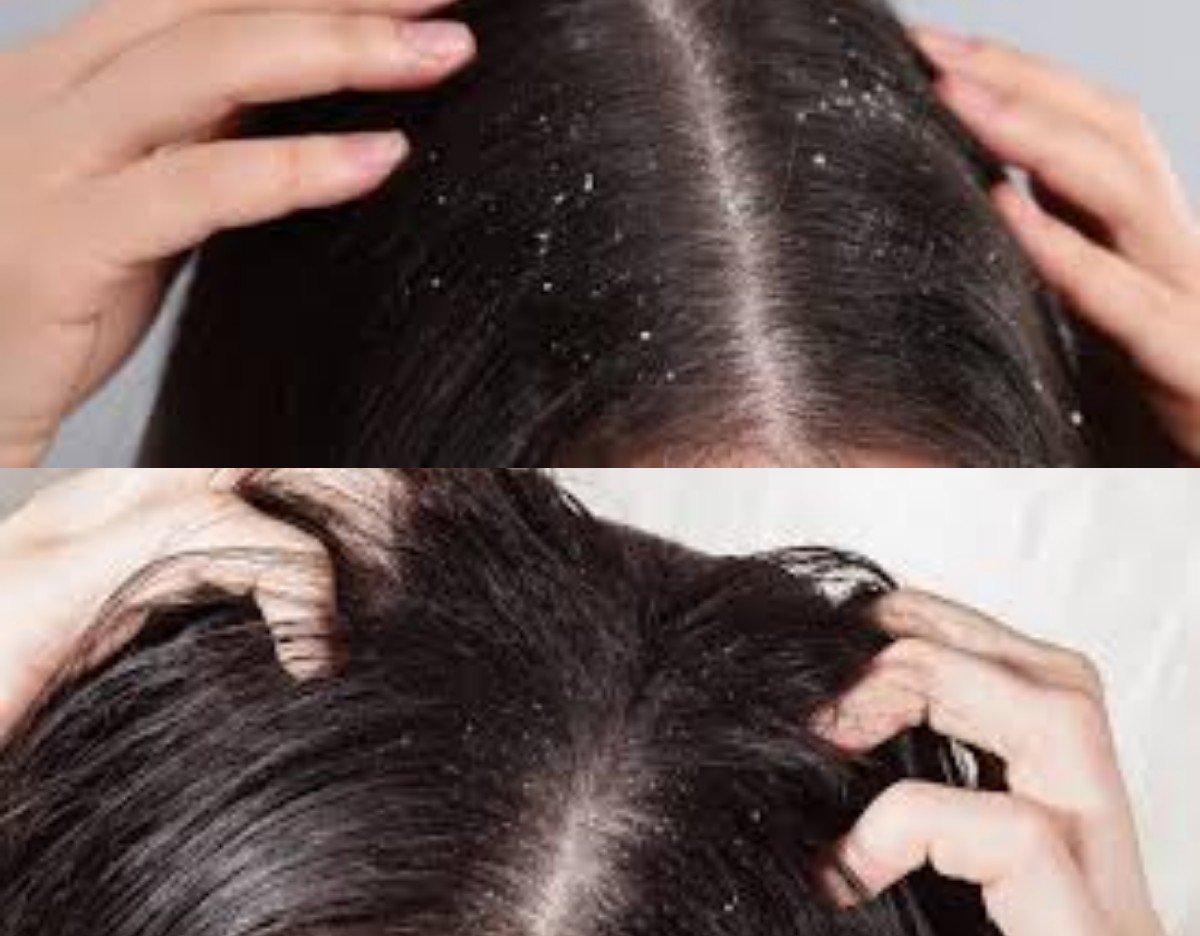 7 Cara Efektif Menjaga Kesehatan Kulit Kepala agar Terbebas dari Ketombe