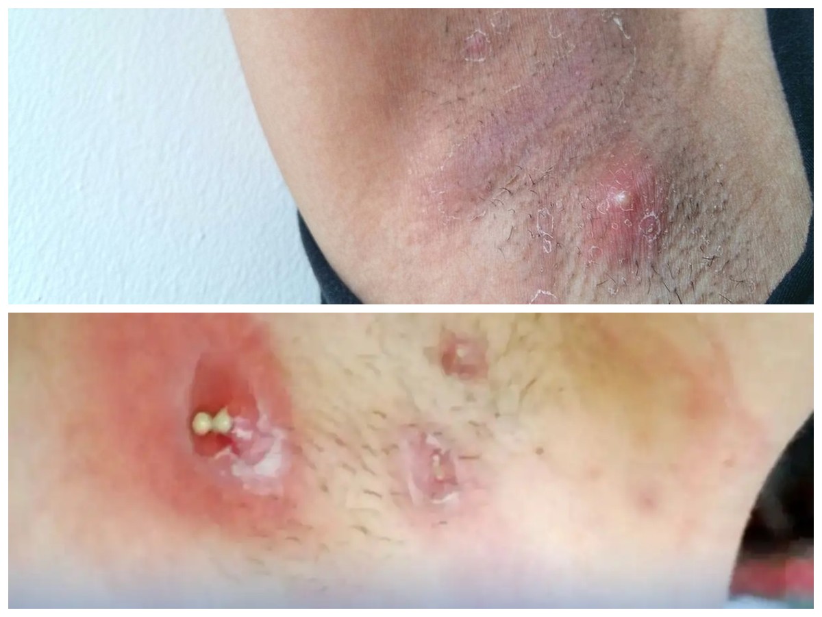 Penyebab Bisul di Ketiak yang Sering Terabaikan dan Cara Mengatasinya