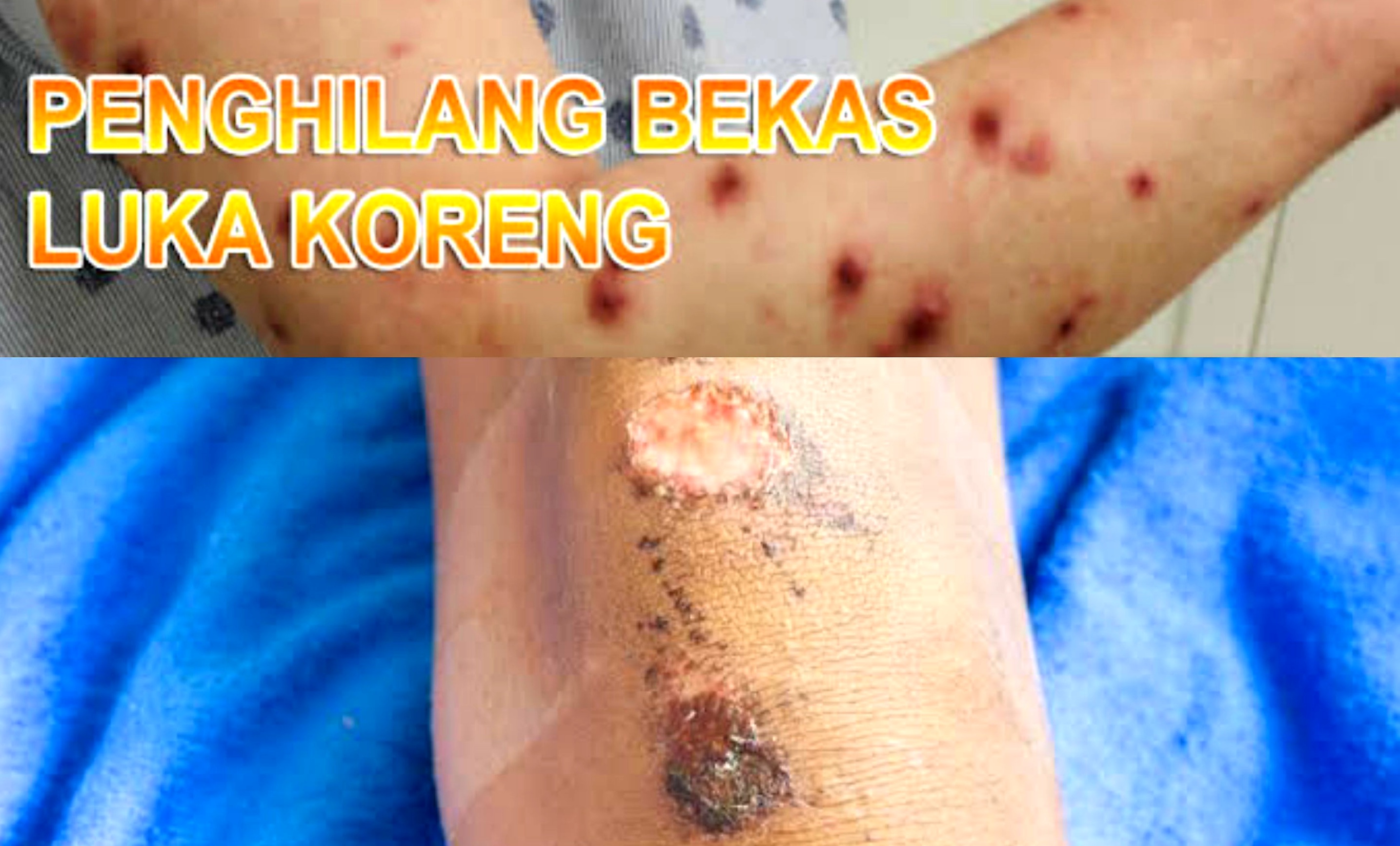 3 Bahan Ampuh Hilangkan Bekas Koreng dan Borok yang Menghitam