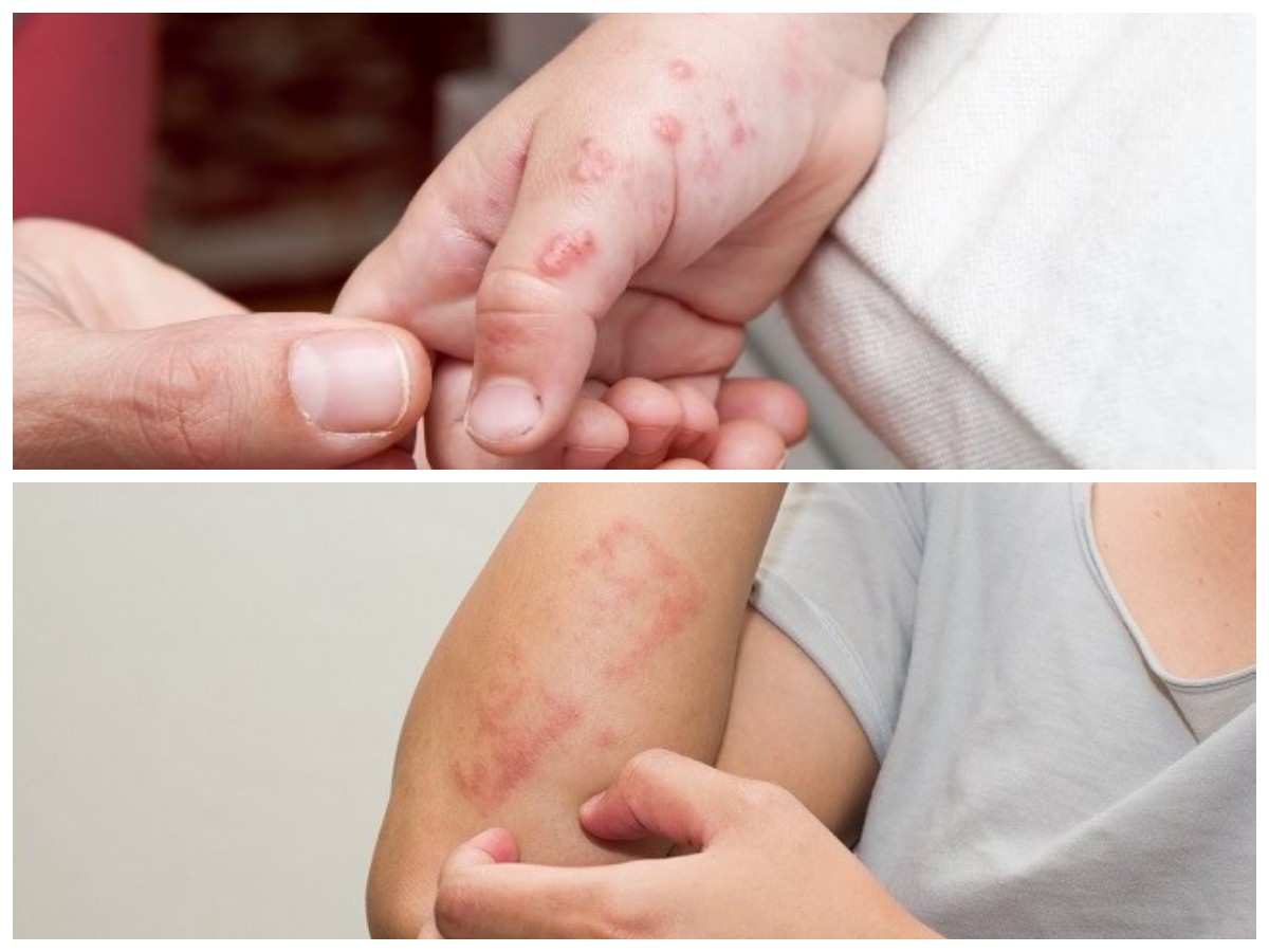 Kenali Berbagai Infeksi Kulit karena Bakteri dan Tips Penanganannya