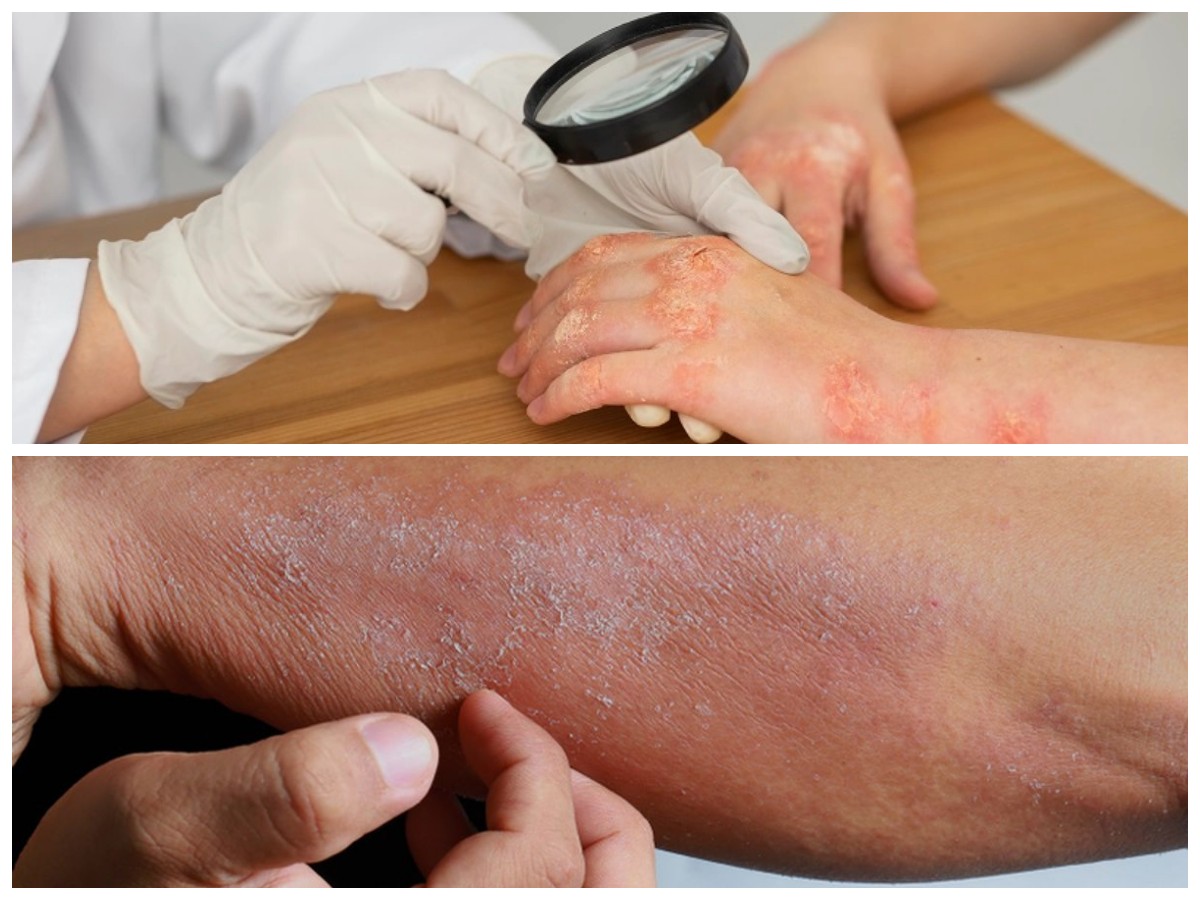 Kenali Jenis-Jenis Infeksi Kulit Karena Bakteri dan Solusi Penanganannya