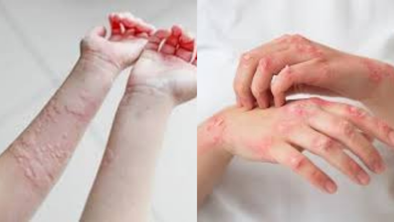 Simak Begini Cara Ampuh Mengatasi Alergi Dingin dan Debu Kamu Harus Tahu!