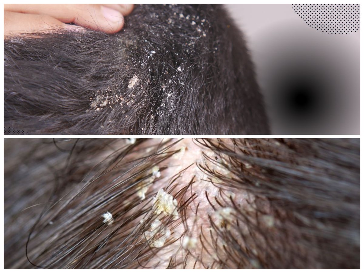 Solusi Praktis Mengatasi Ketombe Membandel Secara Alami