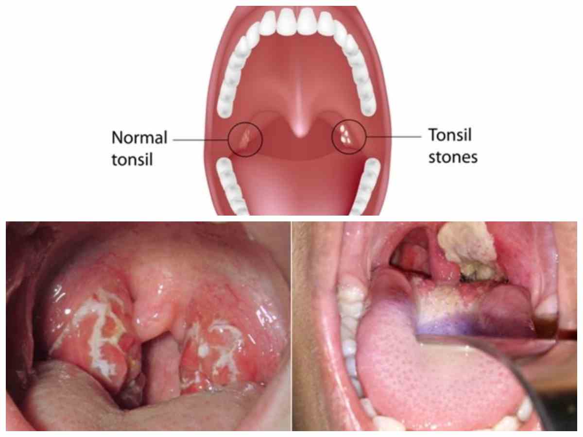Tenggorokan Sering Terasa Tidak Nyaman? Kenali Ciri-Ciri dan Cara Mengatasi Batu Amandel