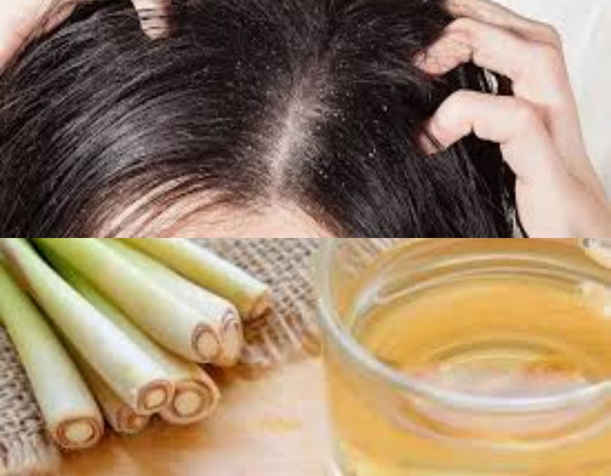 Cara Ampuh Mengatasi Ketombe Membandel, Simak di Bawah ini!