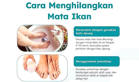 Bukan Kapalan. Ternyata Ini Penyebab Penyakit Mata Ikan dan Cara Mengatasinya