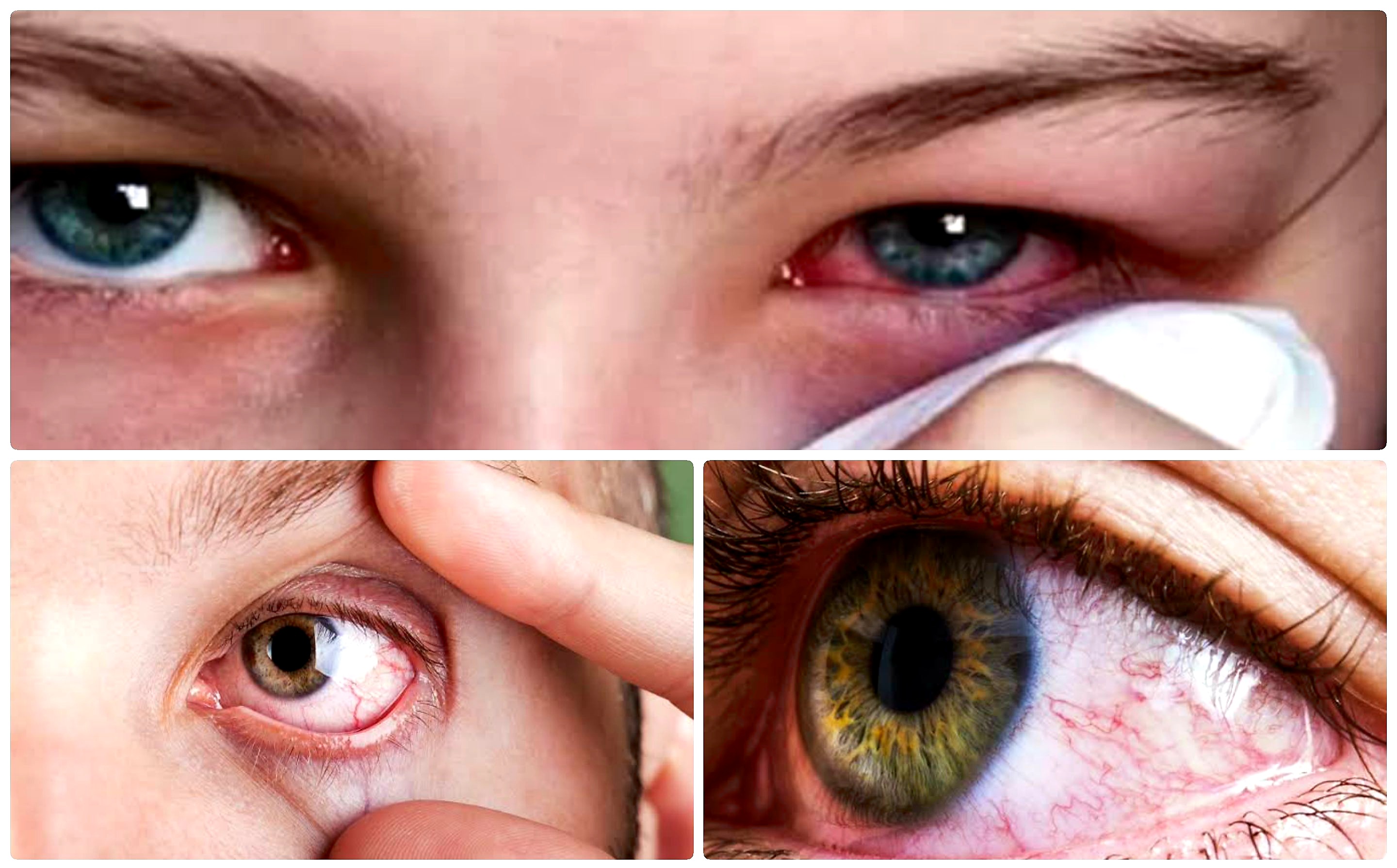 Mata Merah Karena Iritasi Polusi? Begini Mengatasinya!