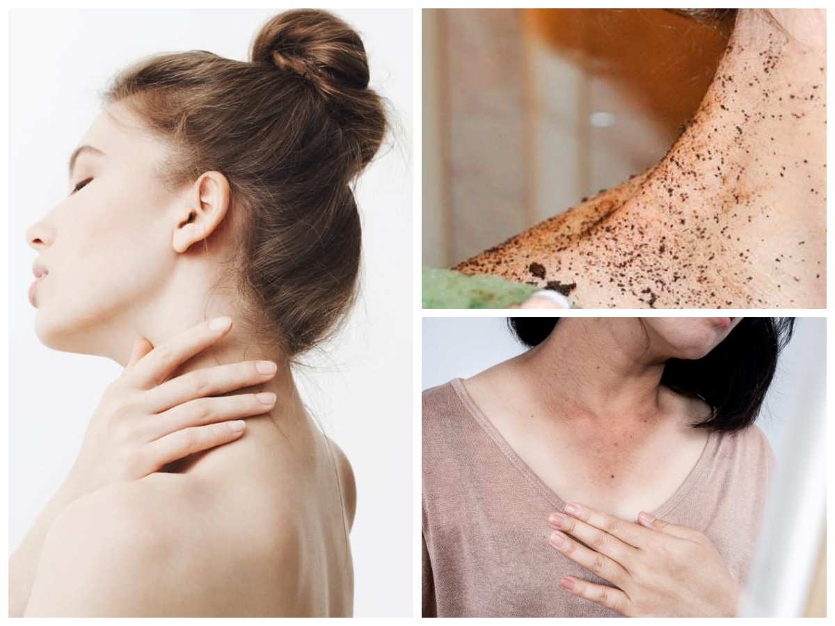 Leher Hitam, Ini Penyebabnya dan Cara Ampuh Mengatasinya Secara Alami dan Medis!