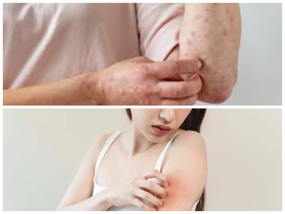 Kupas Tuntas 6 Jenis Penyakit Kulit Paling Umum Beserta Solusinya yang Perlu Diketahui