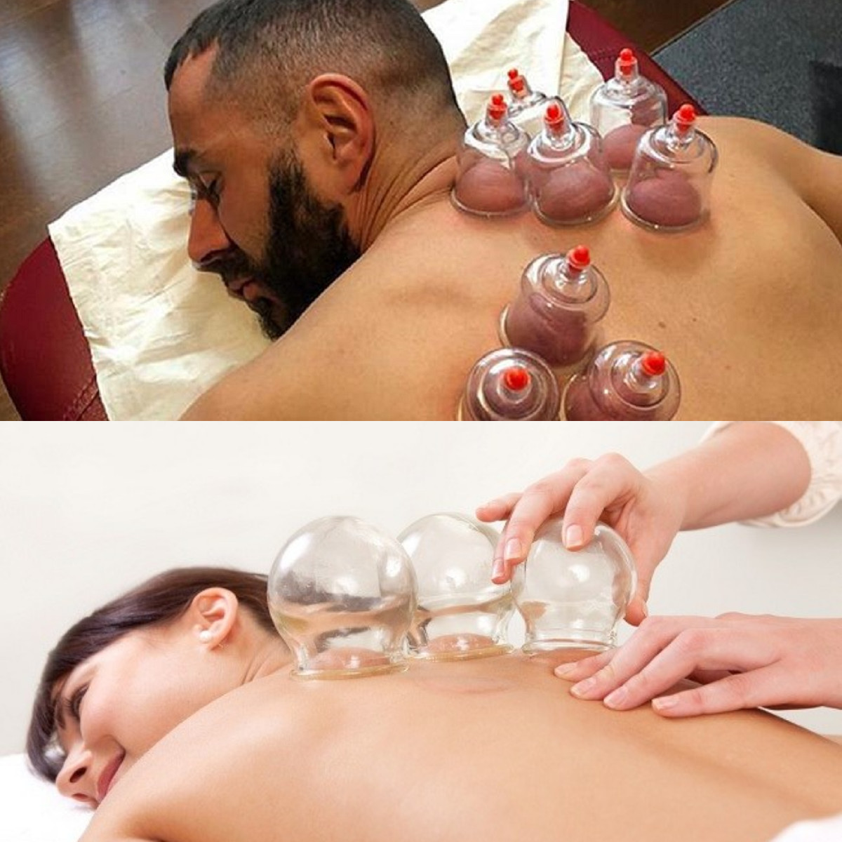 Yuk Intip 9 Keuntungan Terapi Bekam untuk Kesehatan Tubuh!