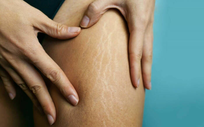 Wah, Kamu Harus Tau Nih 5 Penyebab Stretch Mark dan Cara Mencegahnya