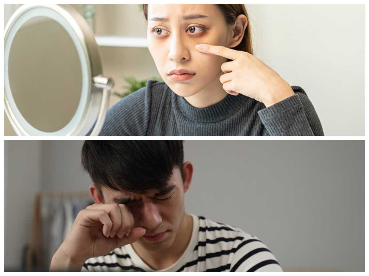 Mata Buram? Ini Penyebab dan Cara Mengatasinya dengan Metode Alami dan Medis