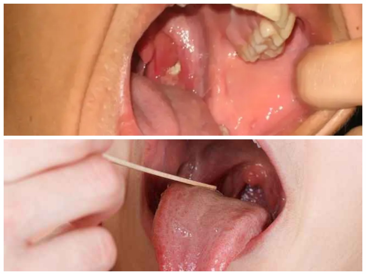 Waspada Batu Amandel: Gejala, Penyebab, dan Cara Mengatasinya*